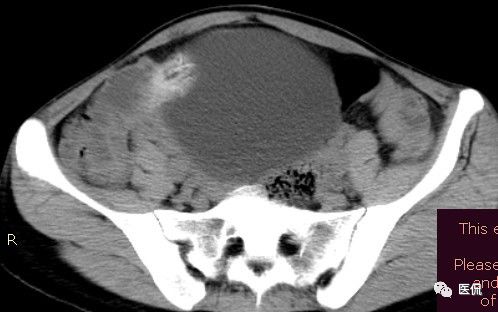 手术纱布遗留在体内可以吸收吗,手术纱布忘了取出会怎样
