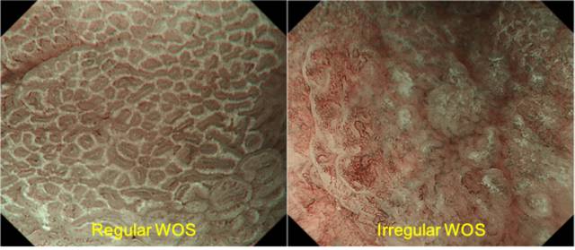内镜检查痛苦吗,内镜检查是怎么做的