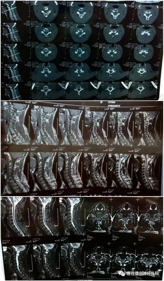 颈椎病嗓子发堵咋回事,喉咙梗阻跟颈椎病有关系吗