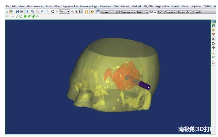 医学3d动画演示脑出血手术,3d演示脑出血治疗过程