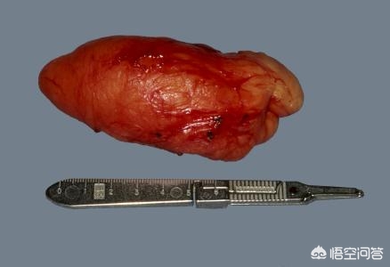 得了脂肪瘤保险豁免,得了脂肪瘤是怎么回事