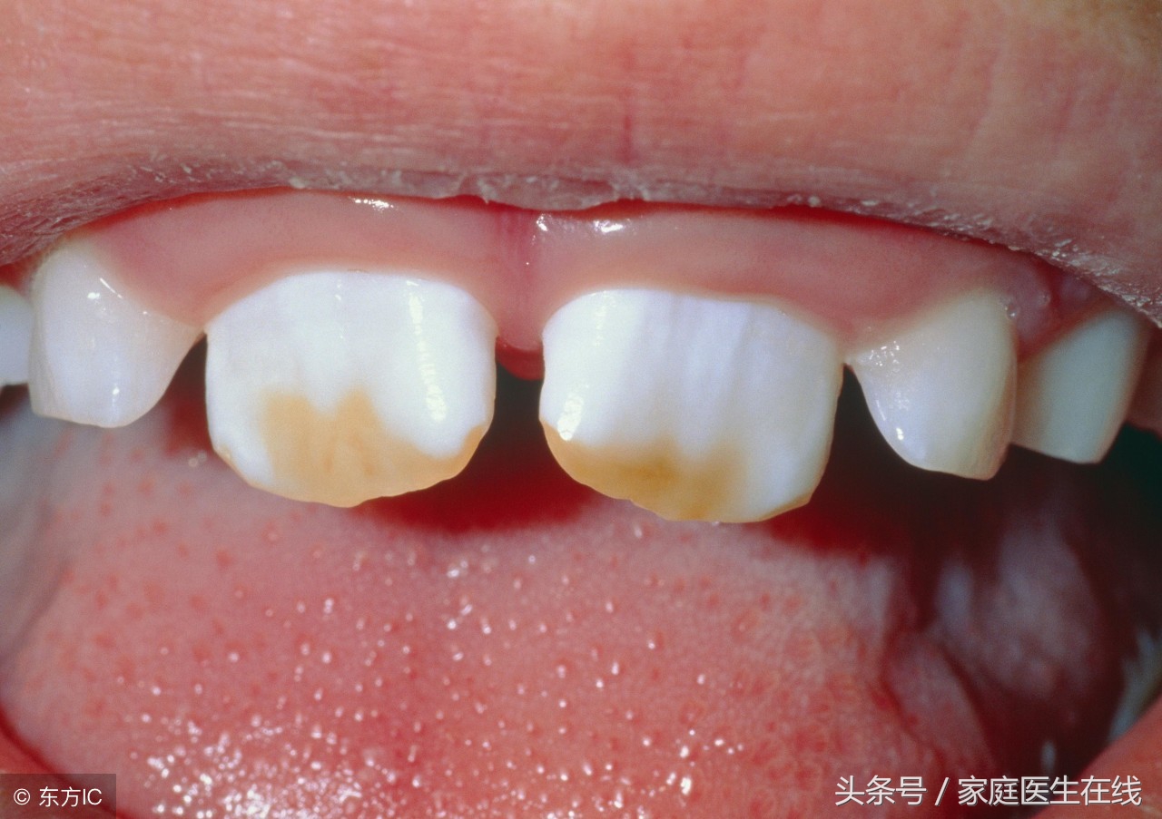 如何不花一分钱让牙齿干净,如何不花钱让牙齿变得白