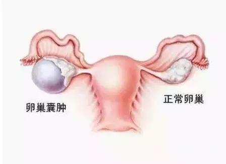 苦尽甘来！曾因为卵巢瘤切除一侧卵巢的她顺利当妈了！