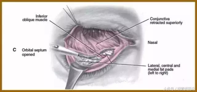 卧蚕会变成眼袋吗,卧蚕是怎么变成眼袋的