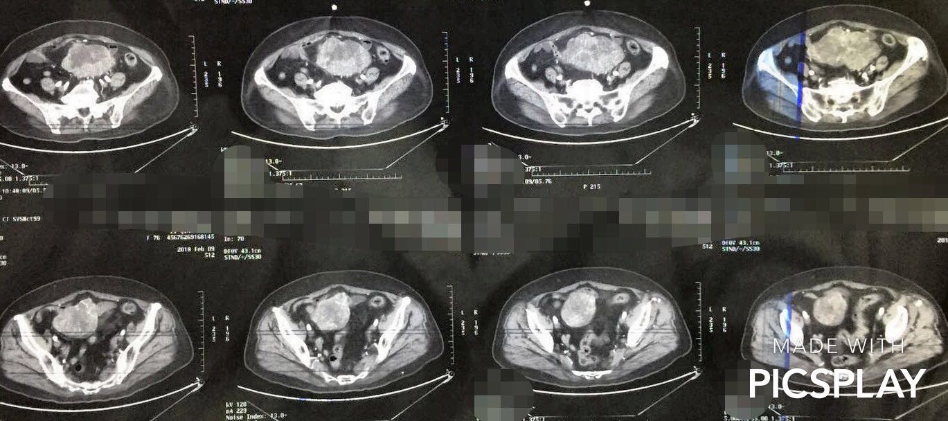 胃肠道间质瘤在临床上有什么特点,胃肠道间质瘤会有什么特征