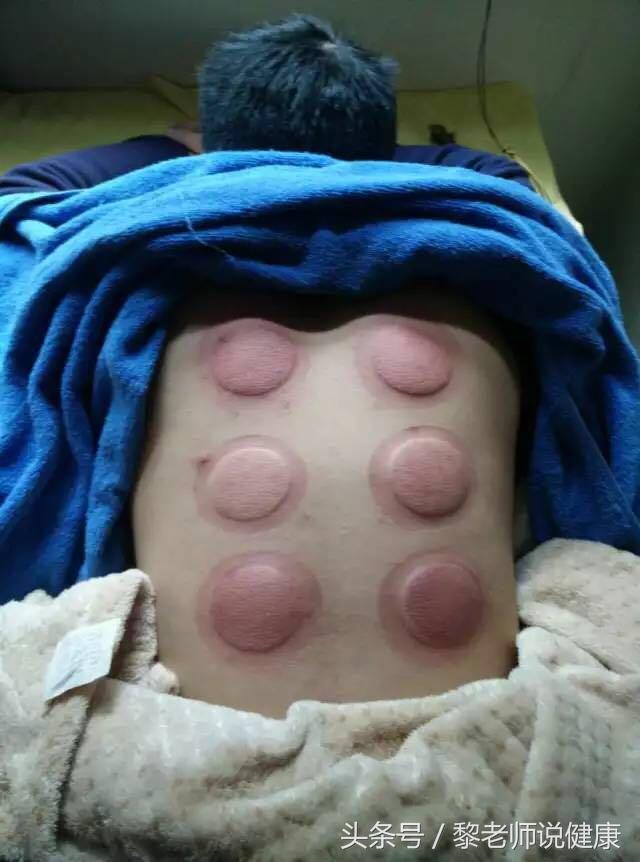 拔罐20分钟出水泡是怎么回事,拔罐后1-7天反应对照表