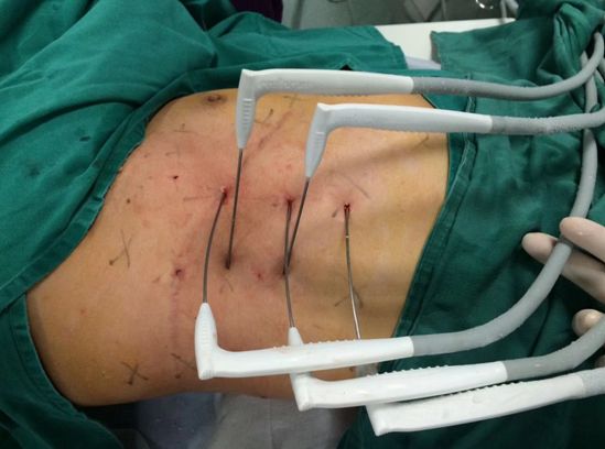 消融技术治癌,冷冻消融治愈癌细胞