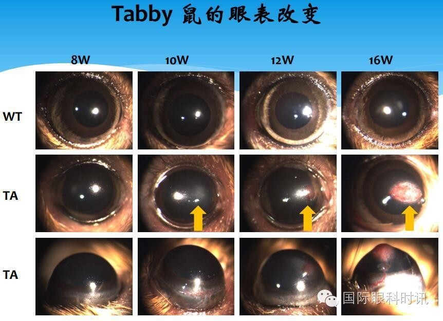 角膜会2016李炜教授:EDA基因突变鼠:一种新的睑板腺功能障碍相关性干眼动物模型