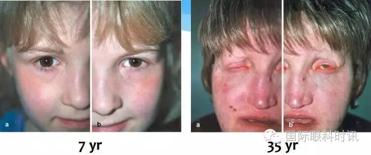 角膜会2016李炜教授:EDA基因突变鼠:一种新的睑板腺功能障碍相关性干眼动物模型