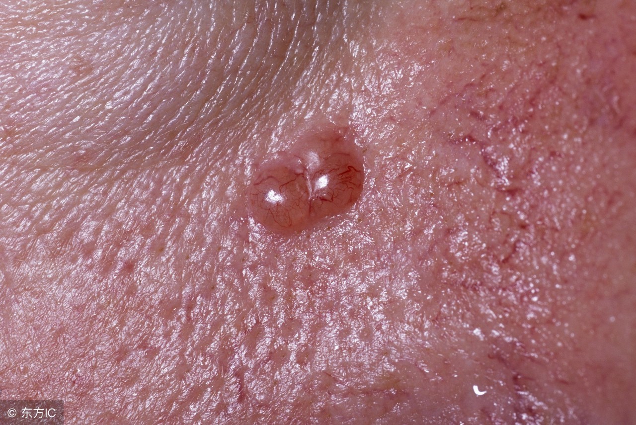 皮肤发硬要当回事，可能是皮肤癌征兆