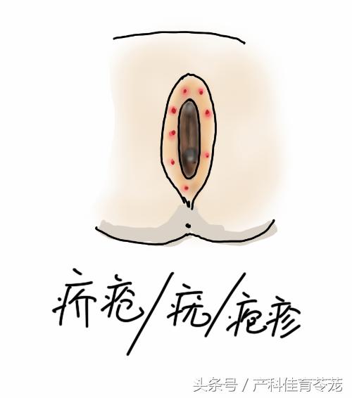 治疗妇科外阴瘙痒用什么洗最好,外阴瘙痒有破溃处擦什么药有效