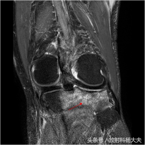 翟晓川的所谓“骨髓水肿”描述不精准，准确的术语是“骨挫伤”