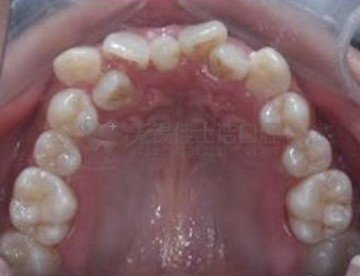牙齿拥挤怎么矫正牙齿,牙齿拥挤矫正方法
