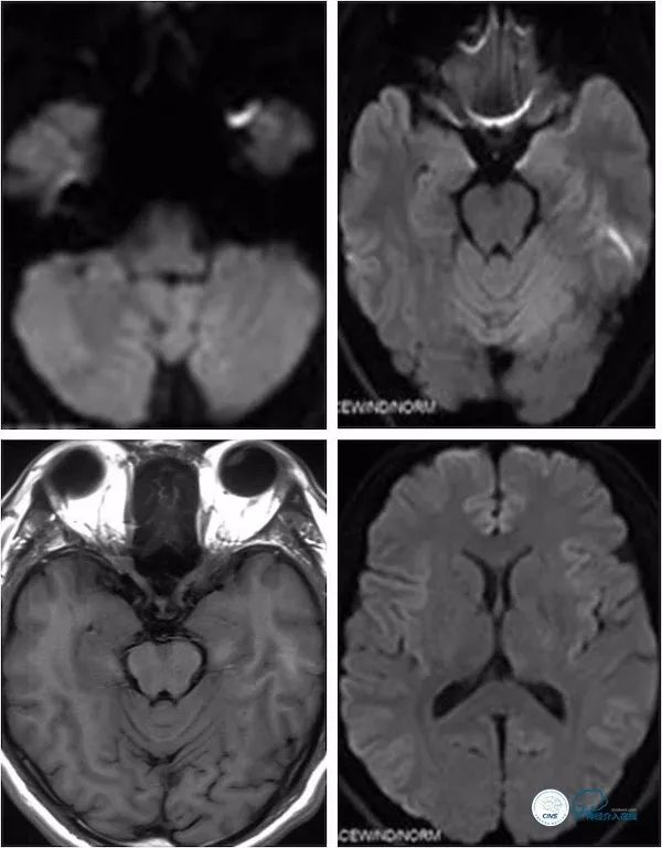 天坛医院做椎动脉狭窄多少要手术,天坛椎动脉狭窄