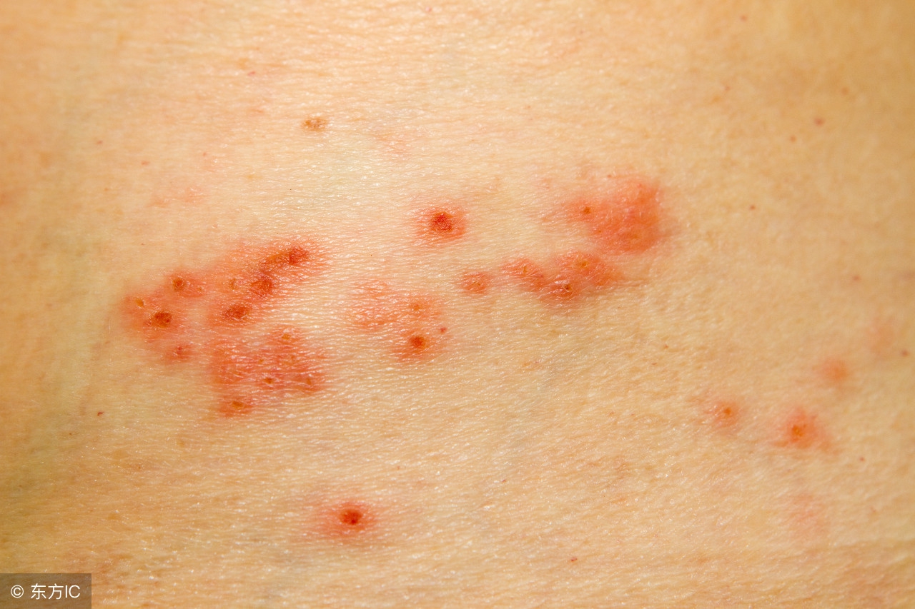 带状疱疹的原因中医,带状疱疹是什么原因引起的危险吗