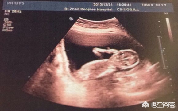 孕妈妈b超检查的全过程,教你读懂产检b超单