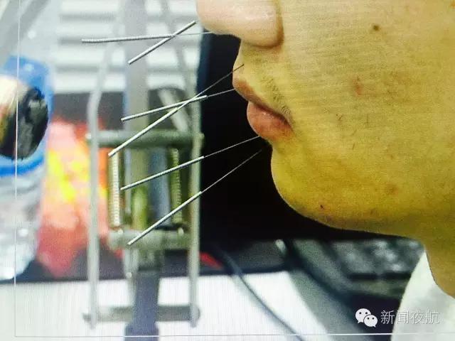 夏季警惕面瘫！哈尔滨一男子从海边回到家后半边脸不会动了！