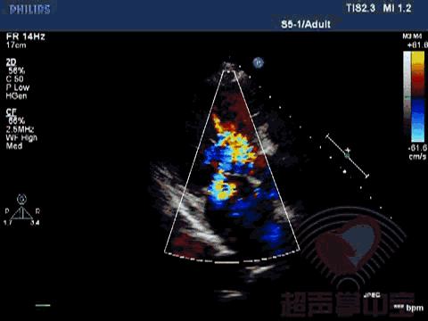 二尖瓣充血性囊肿,二尖瓣血性囊肿是什么意思