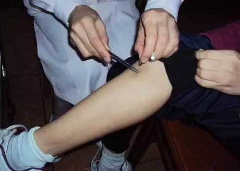 中医无痛蜂疗,中医蜂毒疗法