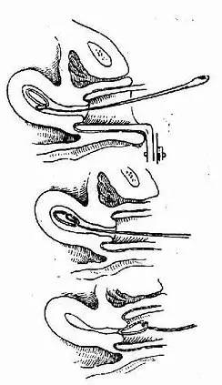 什么样的女性不适合上环,单身女性上环是什么心态