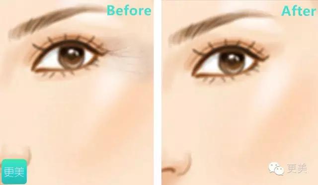 果酸换肤是整容吗,果酸换肤不做后会复发吗