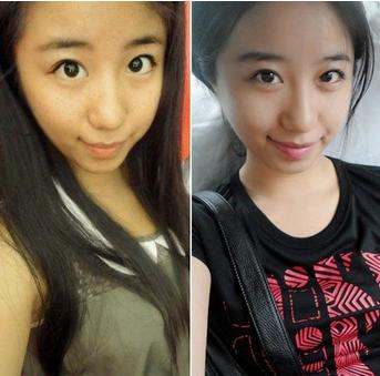 眼角雀斑要怎么消除,最近眼角长了雀斑是怎么回事