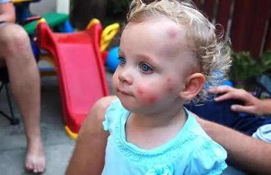 蚊虫咬了红肿硬块很痒用什么方法,被蚊虫咬了一年了还有疙瘩