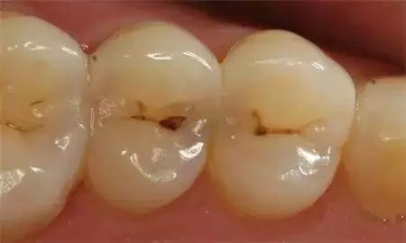 老年人蛀牙很厉害建议拔牙吗,蛀牙快到牙根了需要根管治疗吗