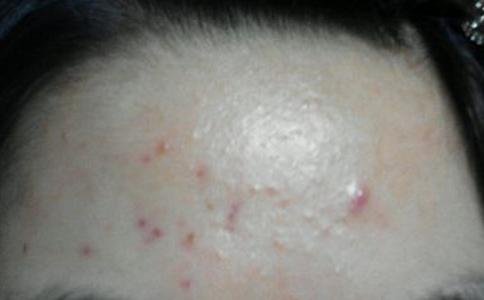 脸上长*疮痤**要如何治疗