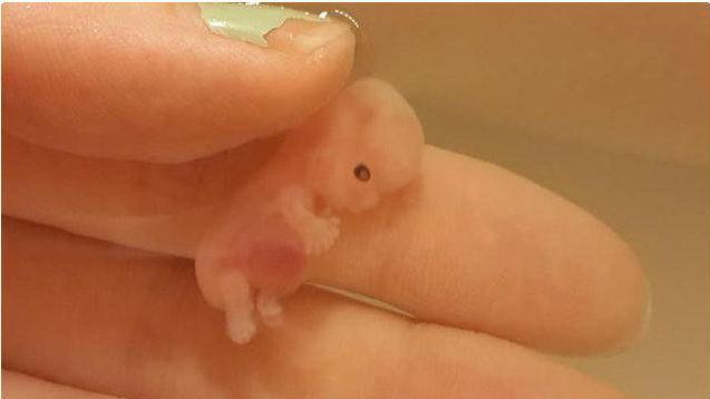 肚子里的胎宝宝停胎了，小月子里，我还是泪流不止，我该怎么办？