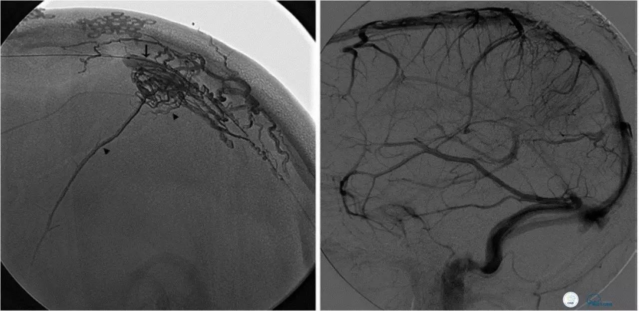 球囊辅助Onyx栓塞治疗硬脑膜动静脉瘘（DAVF）