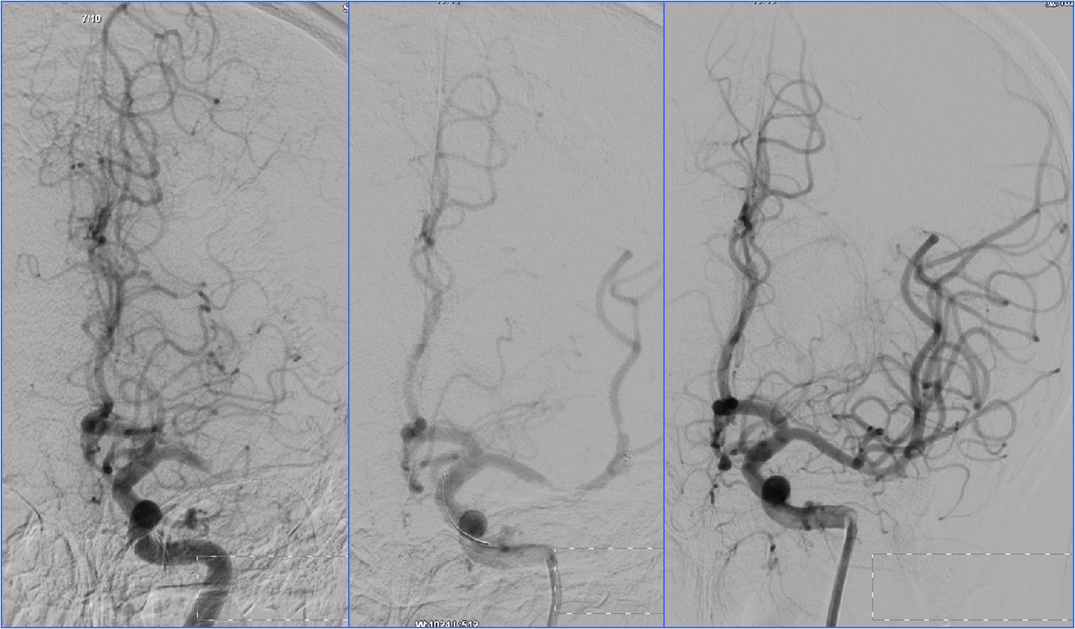 缺血性脑卒中术后管理,急性缺血性脑卒中血管内治疗