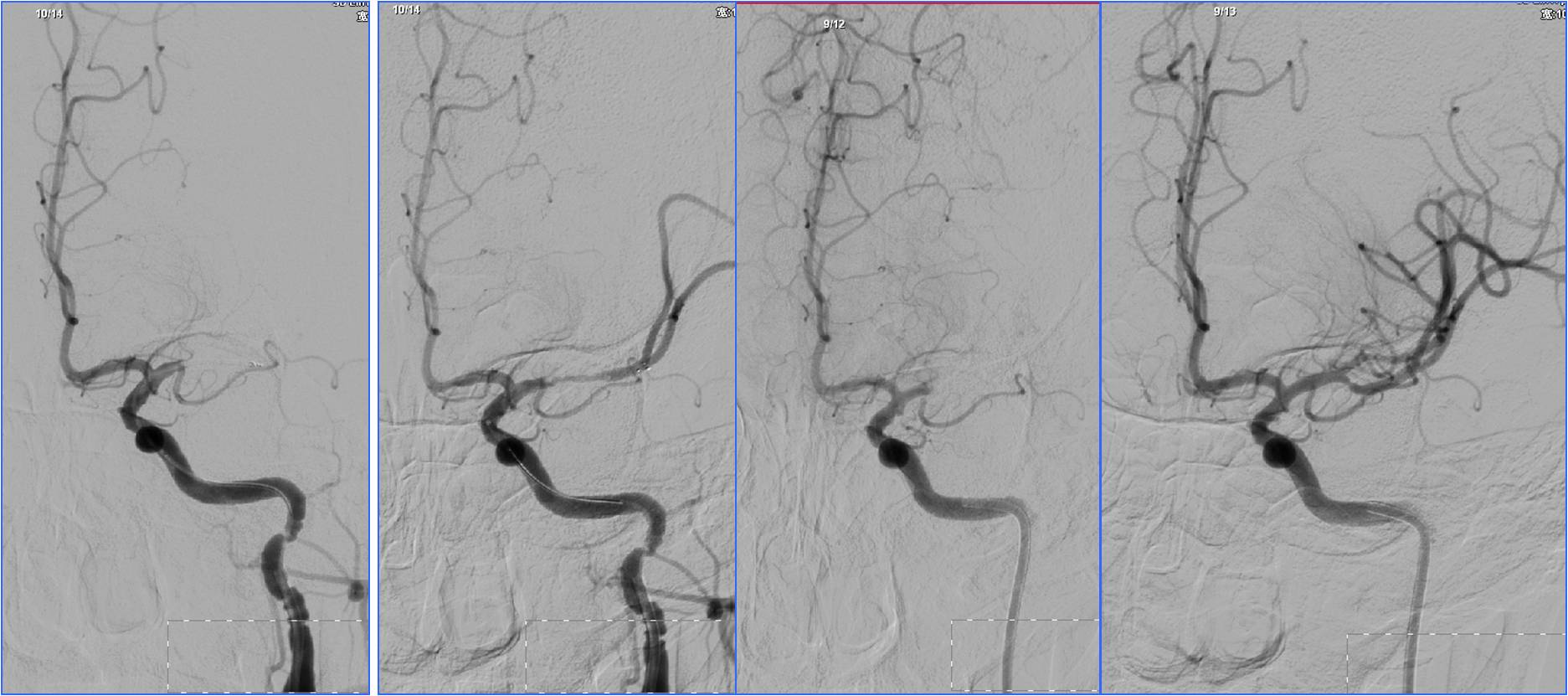 缺血性脑卒中术后管理,急性缺血性脑卒中血管内治疗