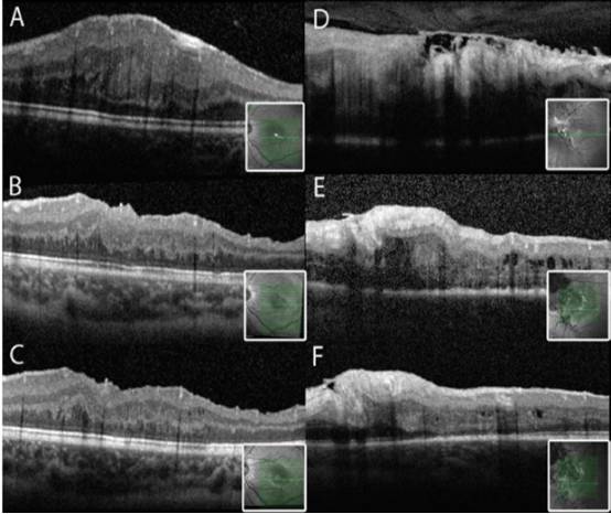 文摘速递儿童视网膜前膜手术的长期疗效