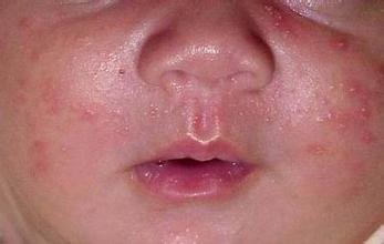 新生儿湿疹转化成脓疱疹,新生儿脸上长湿疹痤疮什么原因