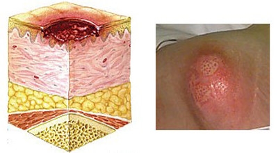 褥疮的护理和治疗方法,褥疮最怕的克星