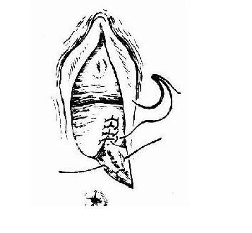 产后顺产妈妈要注意什么问题,侧切妈妈怎么恢复