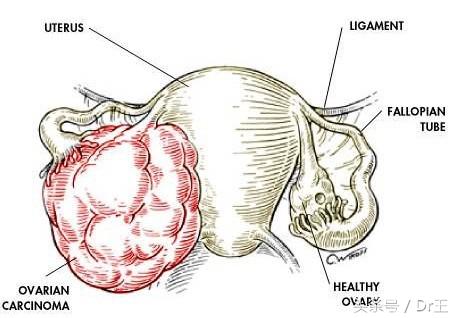 少女异常腹痛，竟因这个东西，才保住卵巢！