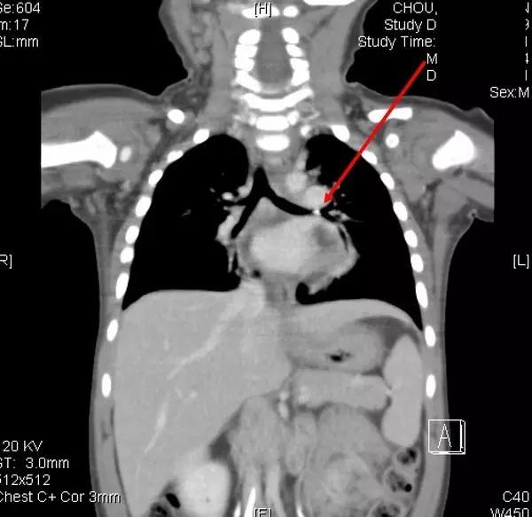 小孩真的什么东西都可以塞进鼻孔?