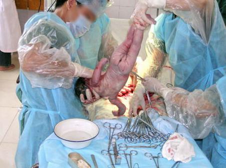 剖腹产的妈妈有多伟大,剖腹产的妈妈最伟大