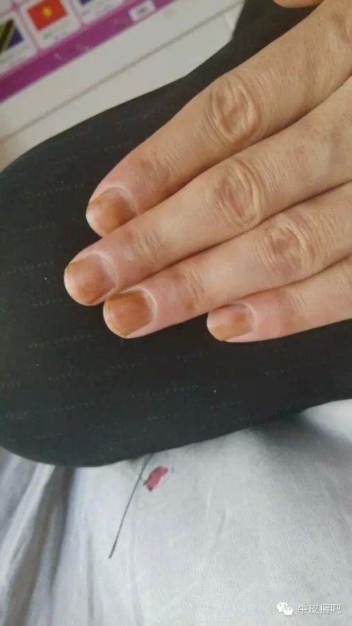 医院专家教你治疗牛皮癣,专家专治牛皮癣方法