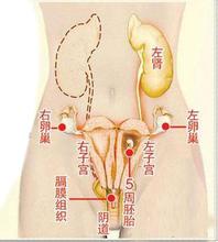 双子宫孕妈产子命悬一线，产检多次医生竟未查出异常