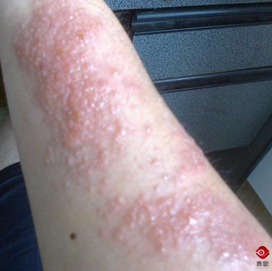 夏日军训旅行防晒,军训脸晒伤了怎么快速恢复