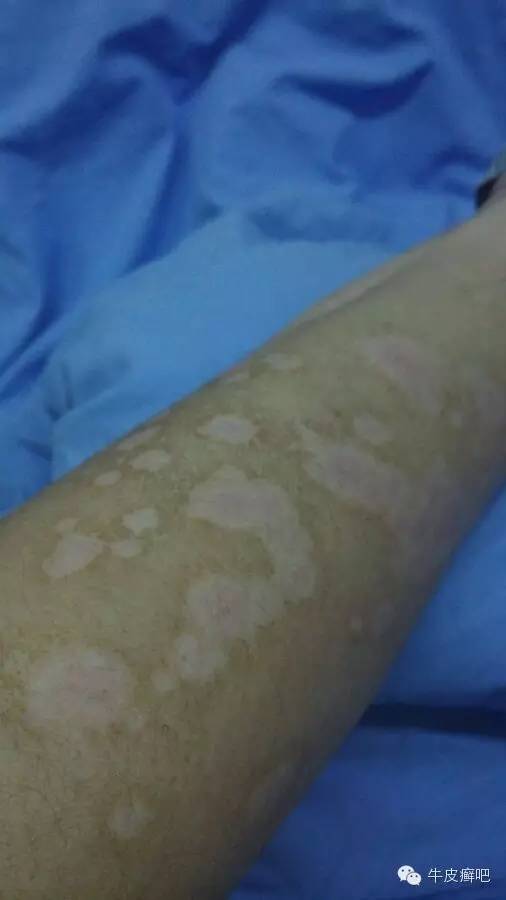 医院专家教你治疗牛皮癣,专家专治牛皮癣方法