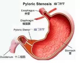 消化性溃疡病例分析真题2020年,消化性溃疡论文参考文献