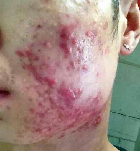 痘痘的分类及形成原因,痘痘的分类和形成原因图片