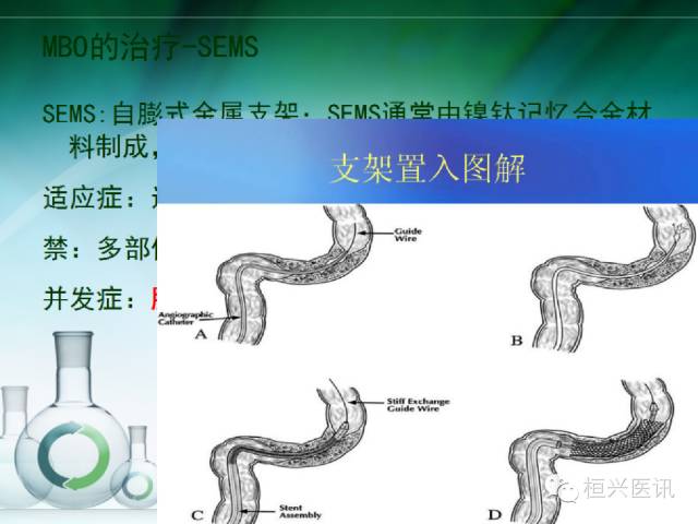 北京协和医院治疗肠梗阻的专家,恶性肠梗阻专家