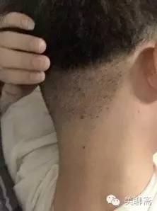 植发亲历,亲身体验植发