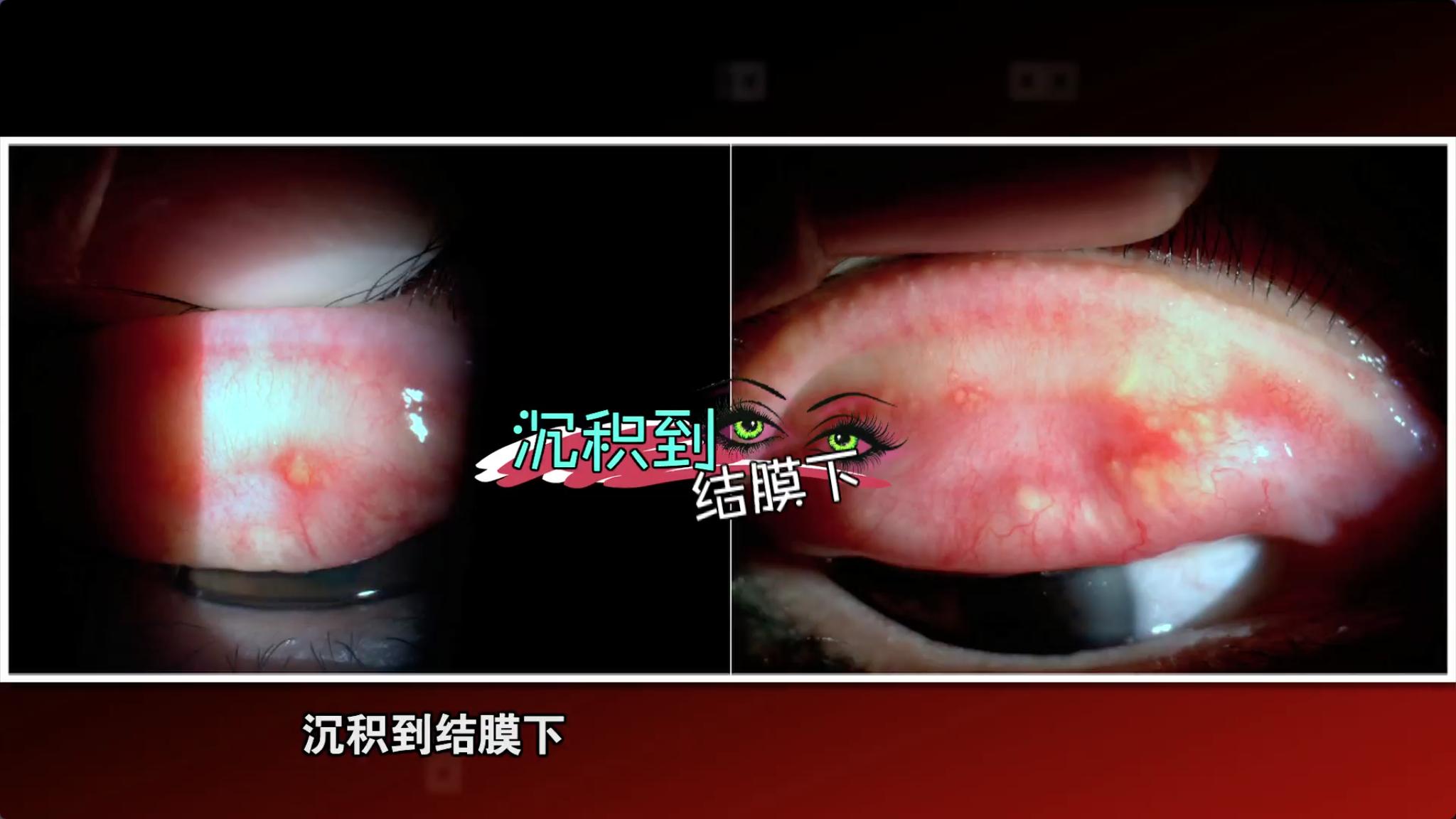 赶快转给爱美的TA！眼妆画太浓易得眼科疾病