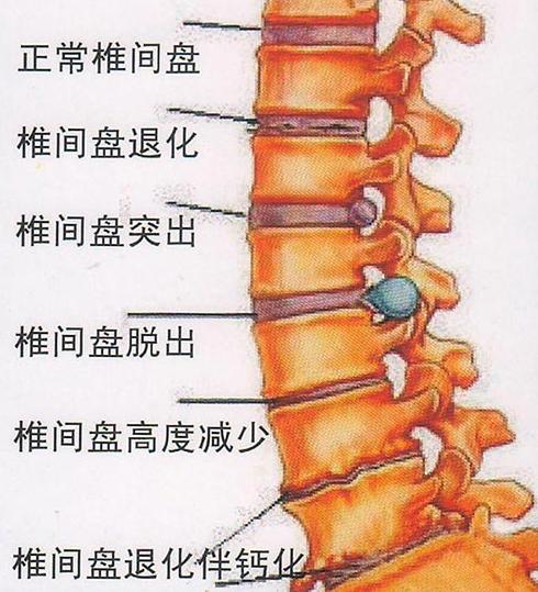 股骨头坏死腰间盘突出的早期信号,早期腰间盘突出吃什么药